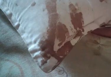 男子熟睡时疑被老鼠咬破耳朵和头 枕头全是血